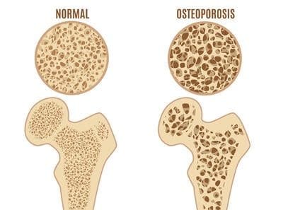 Bone Health After Cancer